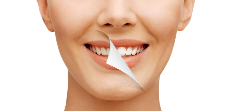 Cosmetic Dentistry for Smile Makeover
